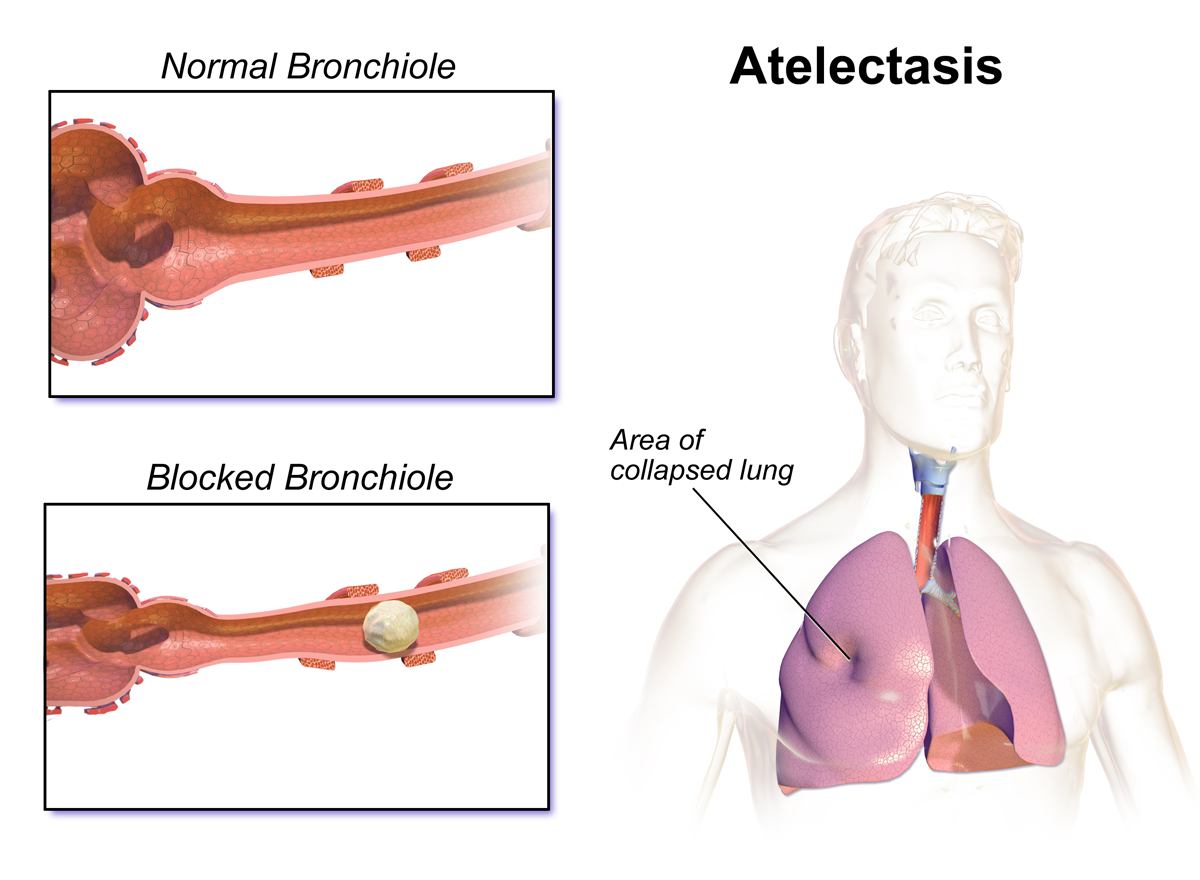 Atelectasia: pulmão normal expandido × pulmão colapsado (alvéolos murchos).