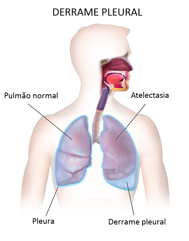 Derrame pleural: líquido no espaço pleural comprimindo o pulmão (em português).