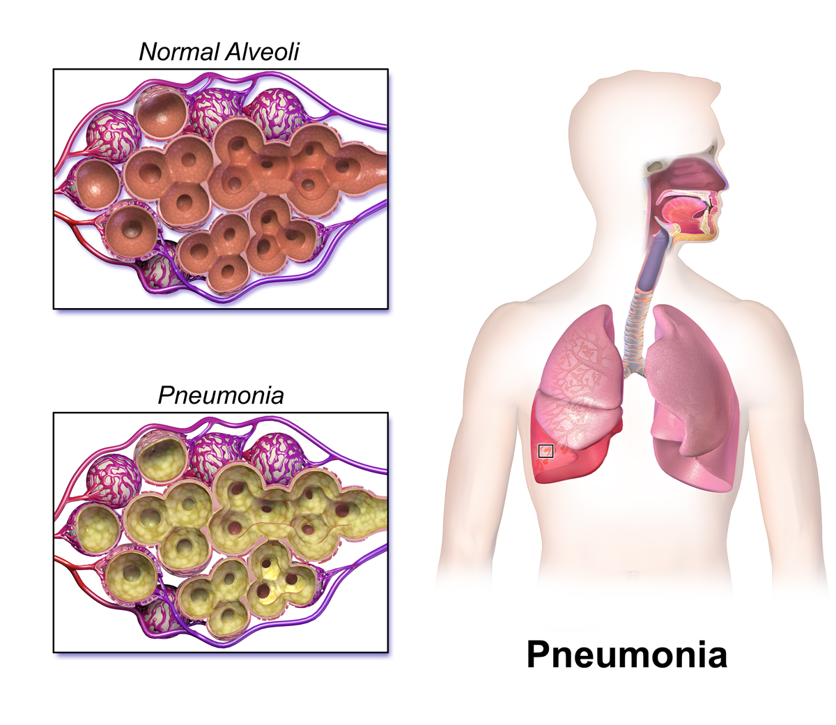 Pneumonia: alvéolos normais (ar) × alvéolos preenchidos por exsudato (consolidação).
