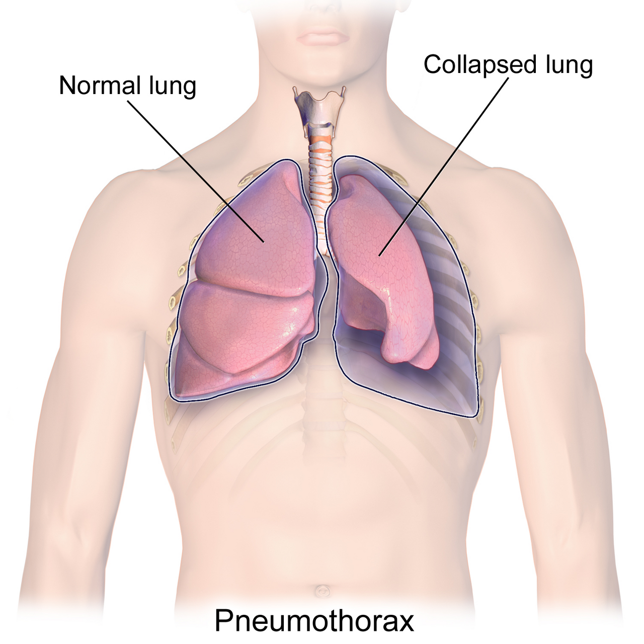 Pneumotórax: ar no espaço pleural com pulmão colapsado × pulmão normal.
